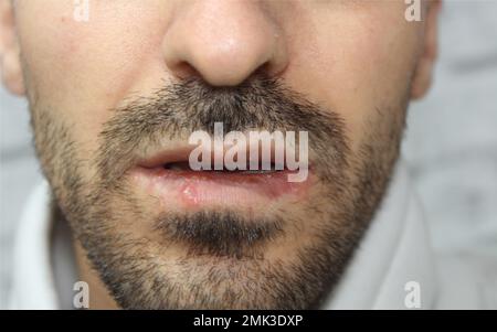 Herpes-Infektion an den Lippen eines Mannes. Nahaufnahme und selektiver Fokus auf Herpes-Infektion. Stockfoto