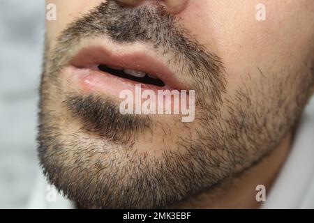 Herpes-Infektion an den Lippen eines Mannes. Nahaufnahme und selektiver Fokus auf Herpes-Infektion. Stockfoto