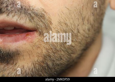 Herpes-Infektion an den Lippen eines Mannes. Nahaufnahme und selektiver Fokus auf Herpes-Infektion. Stockfoto