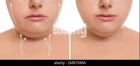 Frau vor und nach plastischer Operation auf weißem Hintergrund, Nahaufnahme. Doppeltes Kinn-Problem Stockfoto