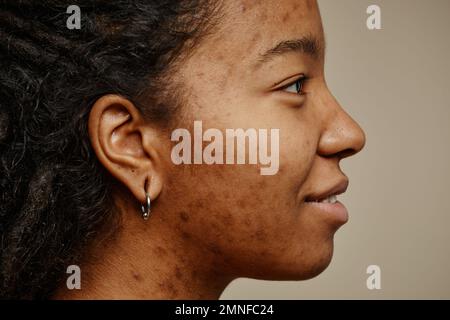 Minimalprofilporträt einer ethnischen jungen Frau, die mit Aknenarben im Gesicht und Ohr lächelt Stockfoto