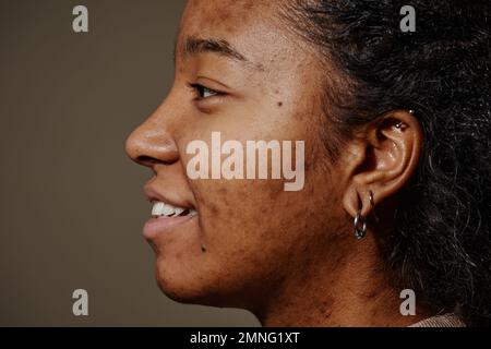 Nahaufnahme von einer lächelnden schwarzen Frau mit Akne-Narben im Gesicht, Fokus auf echte Hautstruktur, Kopierbereich Stockfoto