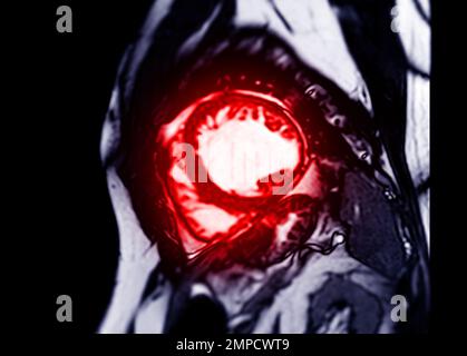 MRT des Herzens oder des Herzens in der Kurzachsenansicht mit Querschnitten des linken und rechten Ventrikels zur Diagnose einer Herzerkrankung. Stockfoto