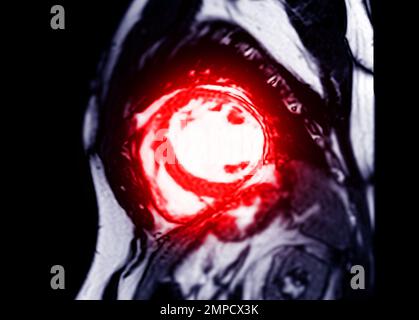 MRT des Herzens oder des Herzens in der Kurzachsenansicht mit Querschnitten des linken und rechten Ventrikels zur Diagnose einer Herzerkrankung. Stockfoto