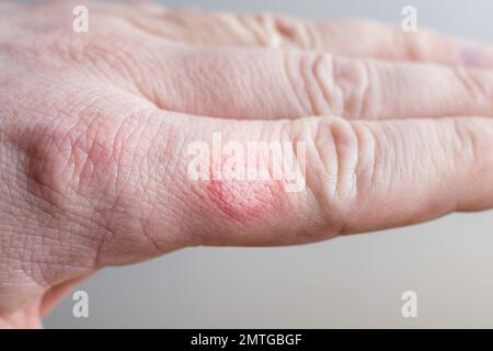 Verbrannte Haut an einem Finger einer weißen Männerhand Stockfoto