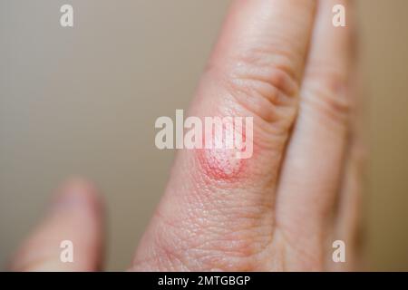 Verbrannte Haut an einem Finger der Kaukasier-Männerhand - Nahaufnahme Stockfoto