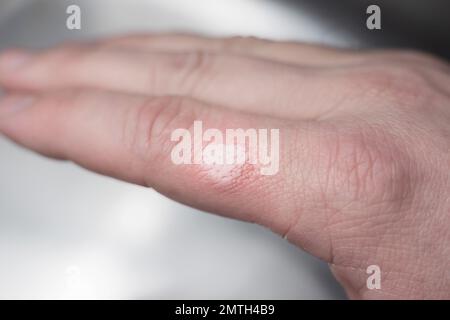 Verbrannte Haut an einem Finger einer weißen Männerhand - Nahaufnahme Stockfoto