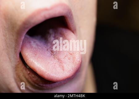 Das Männchen zeigt eine Candidiasis auf der Zunge - oberflächliche Konzentration Stockfoto