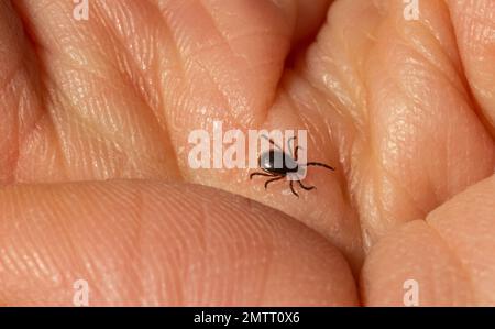 Infektiöse Encephalitis Ixodes scapularis oder Persulcatus Deer Tick Insect auf der Haut. Encephalitis Virus oder Lyme-Borreliose infizierte Ixodes Tick Stockfoto