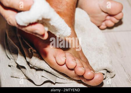 Der Prozess der Behandlung einer Beinverletzung zu Hause. Narbe nach Operation. Knochenersatz. Titanfuß Stockfoto