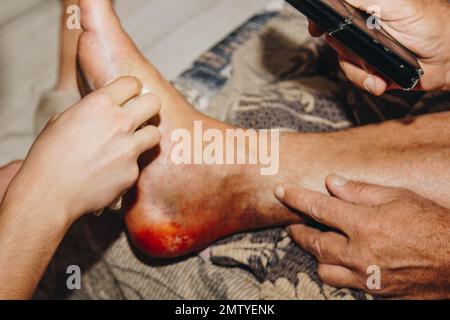 Der Prozess der Behandlung einer Beinverletzung zu Hause. Narbe nach Operation. Knochenersatz. Titanfuß Stockfoto