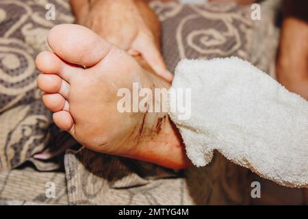 Der Prozess der Behandlung einer Beinverletzung zu Hause. Narbe nach Operation. Knochenersatz. Titanfuß Stockfoto