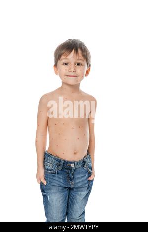 Kleiner Junge mit Windpocken auf weißem Hintergrund. Varicella-Zoster-Virus Stockfoto