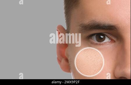 Mann mit trockener Haut auf grauem Hintergrund, Nahaufnahme. Platz für Text Stockfoto