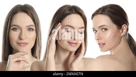 Fotos einer jungen Frau mit Hebungsmarkierungen im Gesicht vor weißem Hintergrund, Collage. Kosmetische Chirurgie Stockfoto