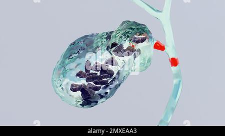 Gallensteine im Gallenblasenund Gallengang, menschliche Silhouette und Anatomie der umgebenden Organe, Leber und Gallenblase mit Steinen, realistische 3D-Renderung Stockfoto
