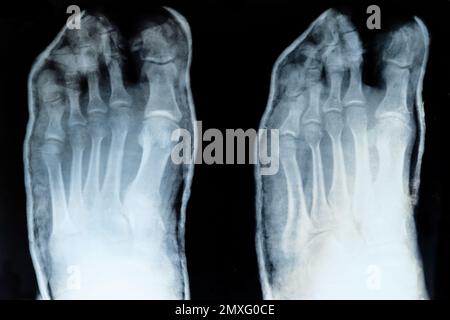 Röntgenaufnahme der Zehen mit verlagertem kleinen Finger Stockfoto