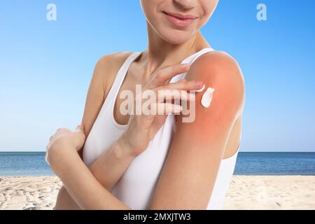 Frau mit Sonnenbrand am Strand, Nahaufnahme. Hautschutz vor Sonneneinstrahlung im Sommer Stockfoto