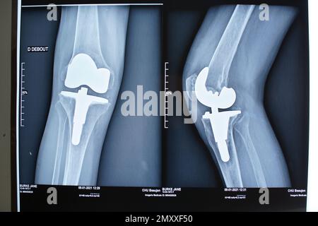 Knietotalersatz-Röntgen - Zimmer NexGen - Arthroplastik, weiblich, Beaujon Krankenhaus, Frankreich Stockfoto