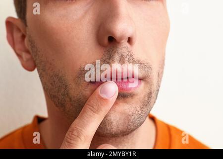 Junger Mann mit Fieberbläschen, der Creme auf die Lippen aufträgt, vor weißem Hintergrund, Nahaufnahme Stockfoto