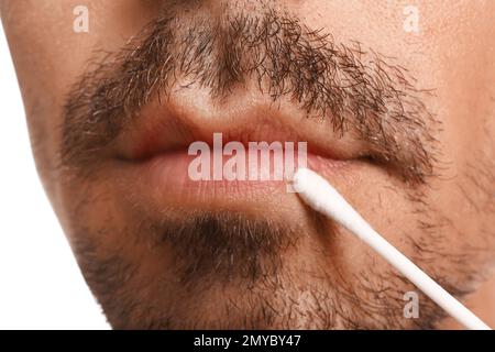 Junger Mann mit Fieberbläschen, der Creme auf die Lippen aufträgt, vor weißem Hintergrund, Nahaufnahme Stockfoto