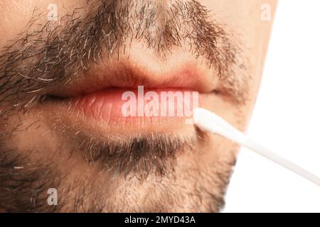 Junger Mann mit Fieberbläschen, der Creme auf die Lippen aufträgt, vor weißem Hintergrund, Nahaufnahme Stockfoto