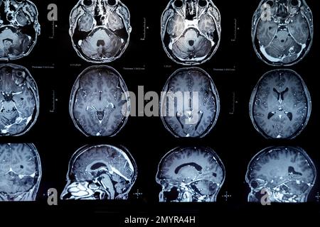 mrt mit Hirntumor. Magnetresonanztomographie. Stockfoto