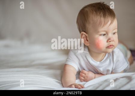 Atopische Dermatitis Ekzem in Baby.Condition, die die Haut zu rot, trocken, wund, juckend und ricked.Atopic Ekzem verursacht am häufigsten betrifft Gesicht in chil Stockfoto