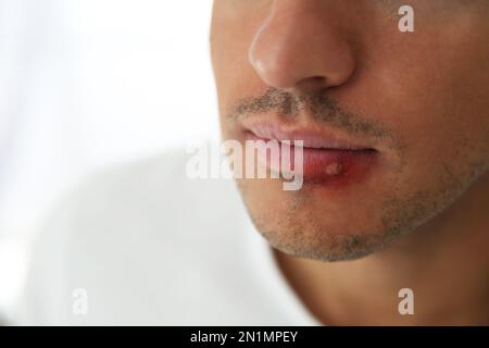 Mann mit Herpes auf der Lippe vor hellem Hintergrund, Nahaufnahme. Platz für Text Stockfoto