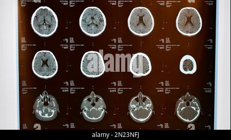 Magnetresonanztomographie des Gehirns nach einer traumatischen Hirnverletzung bei einem älteren männlichen Patienten im Krankenhaus, die zeigt, dass das Gehirn betroffen ist Stockfoto