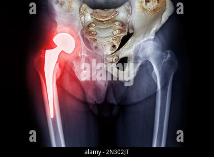 Röntgen der beiden Hüftgelenksersatzteile oder Hüftgelenksprothesen aus Titan mit Fusion-3D-Rendering. Stockfoto