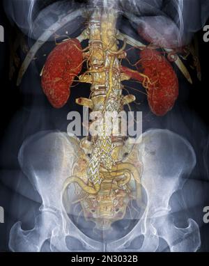 CTA AORTA ABDOMINALIS 3D-Rendering-Fusion mit Röntgenbild des Abdomens. Stockfoto