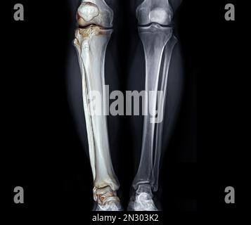 Röntgenbild beider Knie-AP-Ansicht bei diagnostischer Osteoarthritis ...