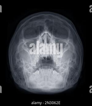 Das Röntgenbild der Nasennebenhöhlen zur Diagnostik der Sinusitis. Stockfoto
