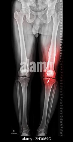 Das Scanogramm ist eine AP-Röntgenaufnahme im Stehen über die gesamte Länge der beiden unteren Extremitäten, einschließlich Hüfte, Knie und Knöchel. Stockfoto