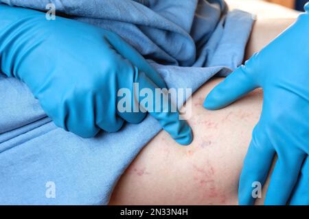 Ein Phlebologe untersucht einen Patienten mit Krampfadern am Bein. Beinschmerzen. Phlebologie. Venöse Pathologien der unteren Extremitäten. Menschliches Gefäß, arter Stockfoto