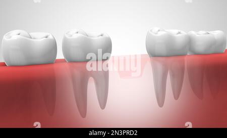 Zahnimplantate in der menschlichen Denturra Stockfoto