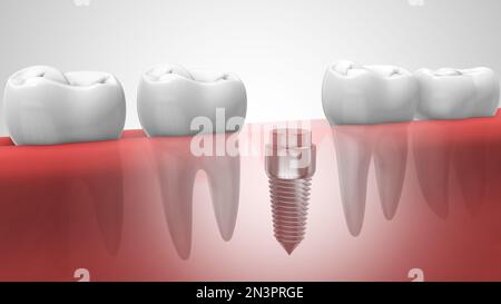 Zahnimplantate in der menschlichen Denturra Stockfoto