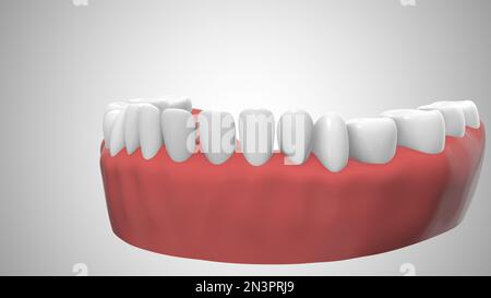 Zahnimplantate im Zahnfleisch Stockfoto