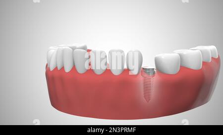 Zahnimplantate im Zahnfleisch Stockfoto