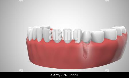 Zahnimplantate im Zahnfleisch Stockfoto