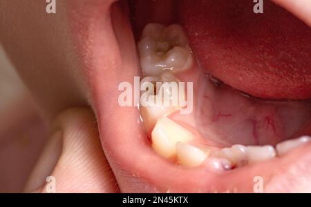 Tiefes Karies bei Kindern auf Milchzähnen. Behandlung von Karies, Zahnschmerzen. Makro Stockfoto