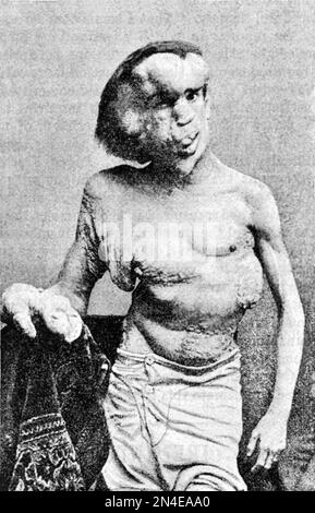 Joseph Merrick, der Elefantenmensch. Das Porträt von Joseph Carey Merrick (1862-1890) mit schweren körperlichen Deformitäten, 1889 Stockfoto