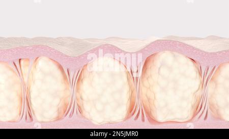 Zellulitis-Hautquerschnitt. Fettzellen und Bindegewebe 3D-gerenderte Illustration Stockfoto