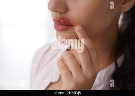 Frau mit Herpes, die Lippen vor hellem Hintergrund berührt, Nahaufnahme Stockfoto