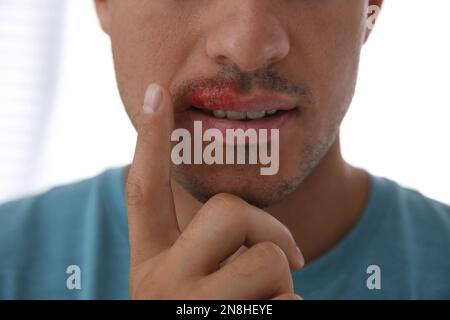 Mann mit Herpes, der Lippen vor hellem Hintergrund berührt, Nahaufnahme Stockfoto