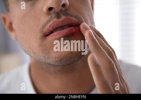 Ein Mann mit Herpes, der die Lippen vor verschwommenem Hintergrund berührt, Nahaufnahme Stockfoto