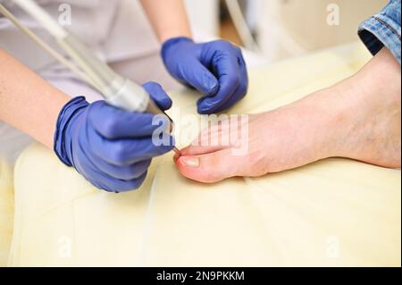 Podologe ist eine Frau, die einen Laser verwendet, um Onychomykose zu behandeln - eine Pilznagelkrankheit. Hardware-Kosmetik Stockfoto