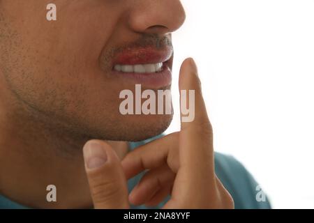 Mann mit Herpes, der Lippen vor hellem Hintergrund berührt, Nahaufnahme Stockfoto