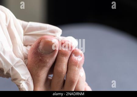 Die Zehen eines Mannes zeigen einen Ausschlag mit roter fleckiger Haut. Eine häufige Nebenwirkung von Covid-19, die oft als Covid-Zeh bezeichnet wird. Stockfoto